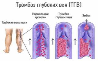 Тромбоз вен нижних конечностей: симптомы, диагностика и лечение