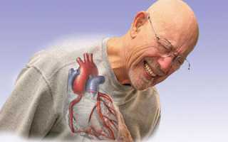 Причины и признаки ишемической болезни сердца