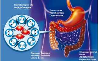 Как вылечить дисбактериоз кишечника