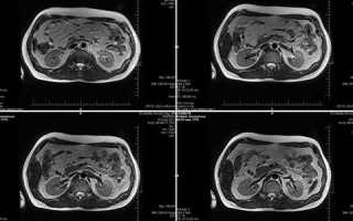 Особенности МРТ почек, надпочечников и мочевыводящих путей