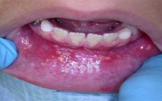 Симптомы и лечение герпетического стоматита у детей