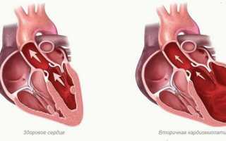 Вторичная кардиомиопатия