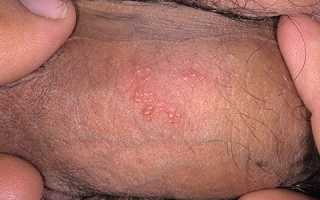 Как выглядит генитальный герпес на интимных местах — симптомы герпетической половой инфекции