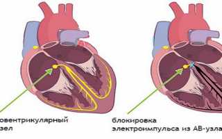 Блокада сердца: что это такое и как ее можно лечить?