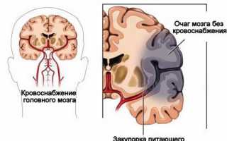 Причины и лечение ишемии головного мозга