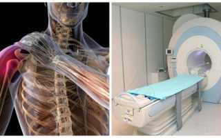 МРТ диагностика патологии плечевого сустава
