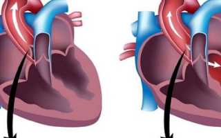 Пороки клапанов сердца