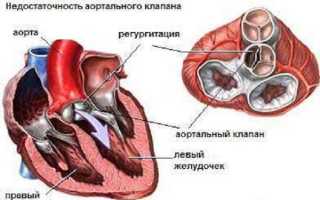 Самые распространённые врождённые пороки сердца у детей и взрослых