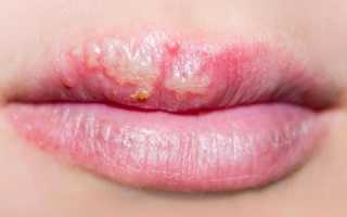 Чем лечить герпес на губах в домашних условиях