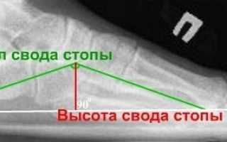 Рентген-исследование стопы при плоскостопии