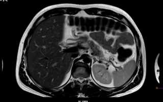 Что показывает МРТ органов брюшной полости