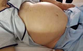 Асцит брюшной полости: причины, признаки, лечение