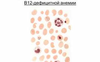 B12 дефицитная анемия