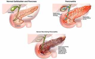 Панкреонекроз: причины, виды, лечение и прогноз