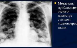 Диагностирование метастазов в легких при рентгеновском исследовании