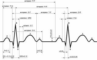 Как распознать инфаркт миокарда по ЭКГ