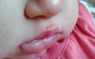 Как и чем лечить герпес на губах у ребёнка — особенности лечения инфекции у детей