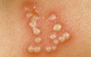 Причины появления герпеса на теле — 5 штаммов герпесвируса вызывающих сыпь